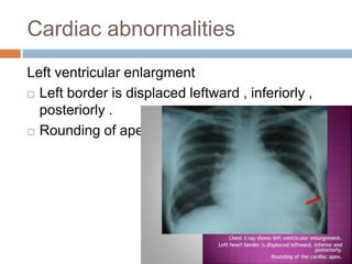 Cardiac abnormalities
Left ventricular enlargment
 Left border is displaced leftward , inferiorly ,
posteriorly .
 Rounding of apex
 