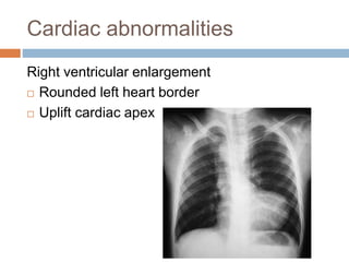 Cardiac abnormalities
Right ventricular enlargement
 Rounded left heart border
 Uplift cardiac apex
 