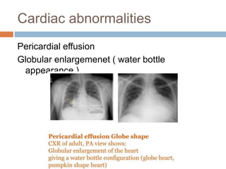 Cardiac abnormalities
Pericardial effusion
Globular enlargemenet ( water bottle
appearance )
 