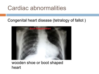 Cardiac abnormalities
Congenital heart disease (tetralogy of fallot )
wooden shoe or boot shaped
heart
 