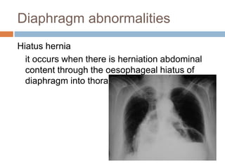 Diaphragm abnormalities
Hiatus hernia
it occurs when there is herniation abdominal
content through the oesophageal hiatus of
diaphragm into thoracic cavity
 
