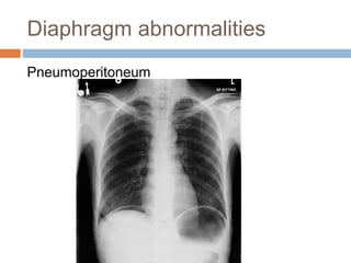 Diaphragm abnormalities
Pneumoperitoneum
 