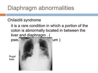 Diaphragm abnormalities
Chilaiditi syndrome
it is a rare condition in which a portion of the
colon is abnormally located in between the
liver and diaphragm . (
pseudopneumoperitoneum )
Rugal
folds
 