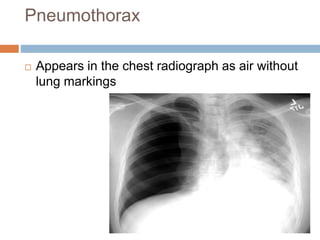 Pneumothorax
 Appears in the chest radiograph as air without
lung markings
 