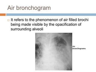 Air bronchogram
 It refers to the phenomenon of air filled brochi
being made visible by the opacification of
surrounding alveoli
 