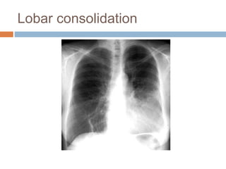 Lobar consolidation
 
