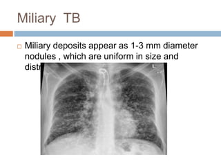 Miliary TB
 Miliary deposits appear as 1-3 mm diameter
nodules , which are uniform in size and
distribution
 