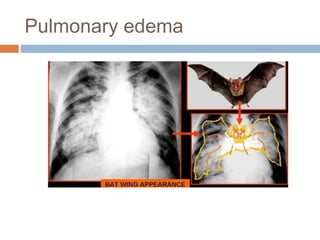 Pulmonary edema
 