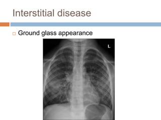Interstitial disease
 Ground glass appearance
 