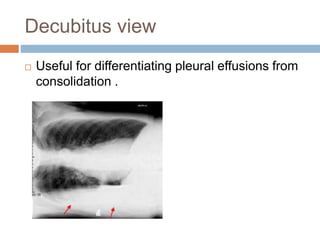 Decubitus view
 Useful for differentiating pleural effusions from
consolidation .
 