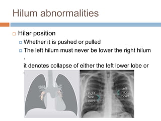 Hilum abnormalities
 Hilar position
 Whether it is pushed or pulled
 The left hilum must never be lower the right hilum
.
it denotes collapse of either the left lower lobe or
of the right upper lobe
 