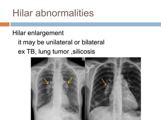 Hilar abnormalities
Hilar enlargement
it may be unilateral or bilateral
ex TB, lung tumor ,silicosis
 