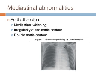 Mediastinal abnormalities
 Aortic dissection
 Mediastinal widening
 Irregularity of the aortic contour
 Double aortic contour
 