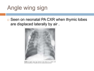 Angle wing sign
 Seen on neonatal PA CXR when thymic lobes
are displaced laterally by air .
 