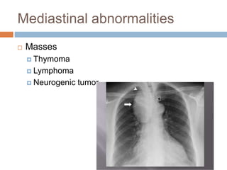 Mediastinal abnormalities
 Masses
 Thymoma
 Lymphoma
 Neurogenic tumor
 
