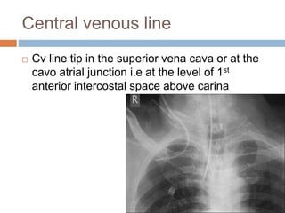 Central venous line
 Cv line tip in the superior vena cava or at the
cavo atrial junction i.e at the level of 1st
anterior intercostal space above carina
 