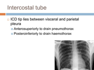 Intercostal tube
 ICD tip lies between visceral and parietal
pleura
 Anterosuperiorly to drain pneumothorax
 Posteroinferiorly to drain haemothorax
 