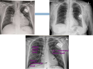 chest X ray basics and interpretation