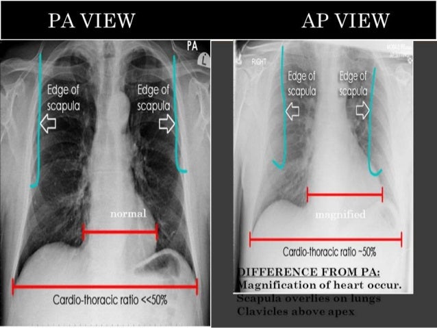 chest X ray basics and interpretation