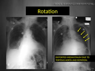 Rotation
DISTORTED MEDIASTINUM DUE TO
TORTOUS AORTA AND ROTATION.
 