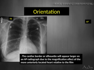 Orientation
PA
AP
. The cardiac border or silhouette will appear larger on
an AP radiograph due to the magnification effect of the
more anteriorly located heart relative to the film
 