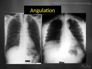 Angulation
 