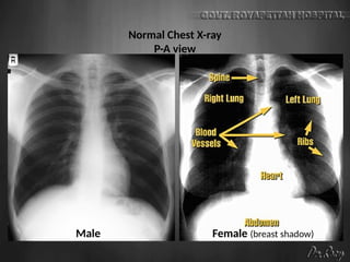 Normal Chest X-ray
P-A view
Male Female (breast shadow)
 