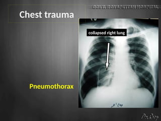 Pneumothorax
collapsed right lung
Chest trauma
 