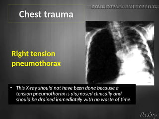 Right tension
pneumothorax
Chest trauma
• This X-ray should not have been done because a
tension pneumothorax is diagnosed clinically and
should be drained immediately with no waste of time
 