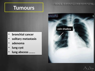 Tumours
• bronchial cancer
• solitary metastasis
• adenoma
• lung cyst
• lung abscess ……..
coin shadow
 