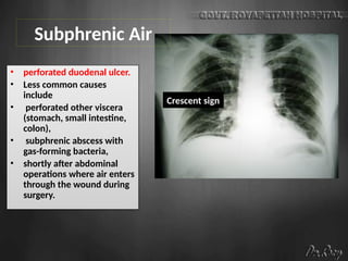 Subphrenic Air
• perforated duodenal ulcer.
• Less common causes
include
• perforated other viscera
(stomach, small intestine,
colon),
• subphrenic abscess with
gas-forming bacteria,
• shortly after abdominal
operations where air enters
through the wound during
surgery.
Crescent sign
 