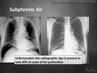 Subphrenic Air
Unfortunately this radiographic sign is present in
only 60% of cases of DU perforation
 