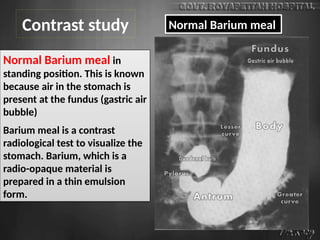 Normal Barium meal in
standing position. This is known
because air in the stomach is
present at the fundus (gastric air
bubble)
Barium meal is a contrast
radiological test to visualize the
stomach. Barium, which is a
radio-opaque material is
prepared in a thin emulsion
form.
Contrast study Normal Barium meal
 