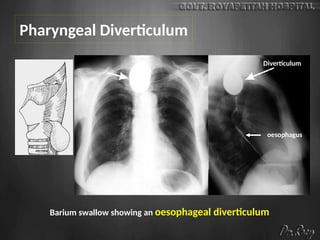 Pharyngeal Diverticulum
Barium swallow showing an oesophageal diverticulum
Diverticulum
oesophagus
 