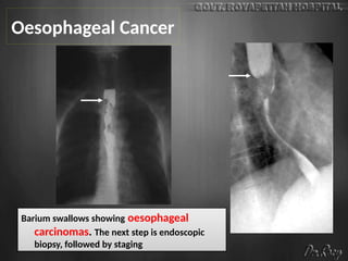 Oesophageal Cancer
Barium swallows showing oesophageal
carcinomas. The next step is endoscopic
biopsy, followed by staging
 