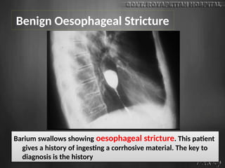 Benign Oesophageal Stricture
Barium swallows showing oesophageal stricture. This patient
gives a history of ingesting a corrhosive material. The key to
diagnosis is the history
 
