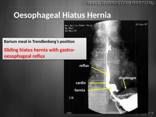 cardia
hernia
reflux
diaphragm
Barium meal in Trendlenberg’s position
Sliding hiatus hernia with gastro-
oesophageal reflux
Oesophageal Hiatus Hernia
 