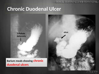 Chronic Duodenal Ulcer
Barium meals showing chronic
duodenal ulcers
ulcer
Trifoliate
deformity
 