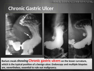Chronic Gastric Ulcer
Barium meals showing Chronic gastric ulcers on the lesser curvature,
which is the typical position of a benign ulcer. Endoscopy and multiple biopsies
are, nevertheless, essential to rule out malignancy.
 