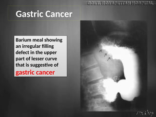 Gastric Cancer
Barium meal showing
an irregular filling
defect in the upper
part of lesser curve
that is suggestive of
gastric cancer
 