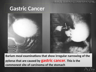 Barium meal examinations that show irregular narrowing of the
pylorus that are caused by gastric cancer. This is the
commonest site of carcinoma of the stomach
Gastric Cancer
 