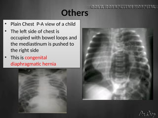 Others
• Plain Chest P-A view of a child
• The left side of chest is
occupied with bowel loops and
the mediastinum is pushed to
the right side
• This is congenital
diaphragmatic hernia
 