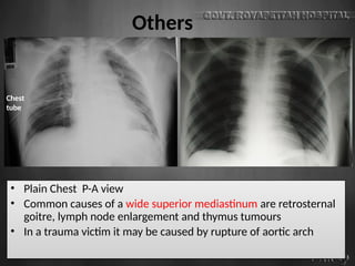 Others
• Plain Chest P-A view
• Common causes of a wide superior mediastinum are retrosternal
goitre, lymph node enlargement and thymus tumours
• In a trauma victim it may be caused by rupture of aortic arch
Chest
tube
 