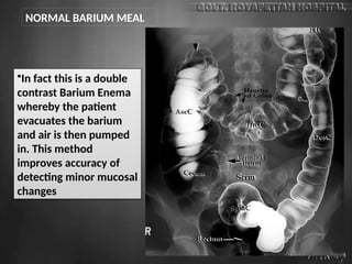 •In fact this is a double
contrast Barium Enema
whereby the patient
evacuates the barium
and air is then pumped
in. This method
improves accuracy of
detecting minor mucosal
changes
NORMAL BARIUM MEAL
 