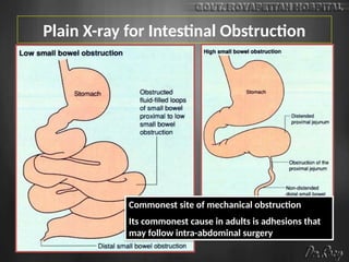 Plain X-ray for Intestinal Obstruction
Commonest site of mechanical obstruction
Its commonest cause in adults is adhesions that
may follow intra-abdominal surgery
 