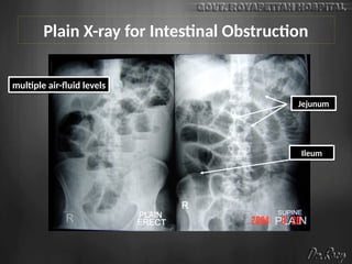 Plain X-ray for Intestinal Obstruction
Jejunum
Ileum
multiple air-fluid levels
 