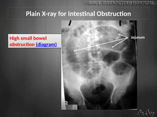 Plain X-ray for Intestinal Obstruction
High small bowel
obstruction (diagram)
Jejunum
 