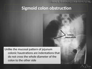 Sigmoid colon obstruction
Colonic
haustrations
Unlike the mucosal pattern of jejunum
colonic haustrations are indentations that
do not cross the whole diameter of the
colon to the other side
 
