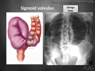 Sigmoid volvulus Omega
loop
 