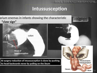 Intussusception
colon
Head of
intussusception
claws
colon
At surgery reduction of intussusception is done by pushing
its head backwards never by pulling on the ileum
arium enemas in infants showing the characteristic
“claw sign”
 
